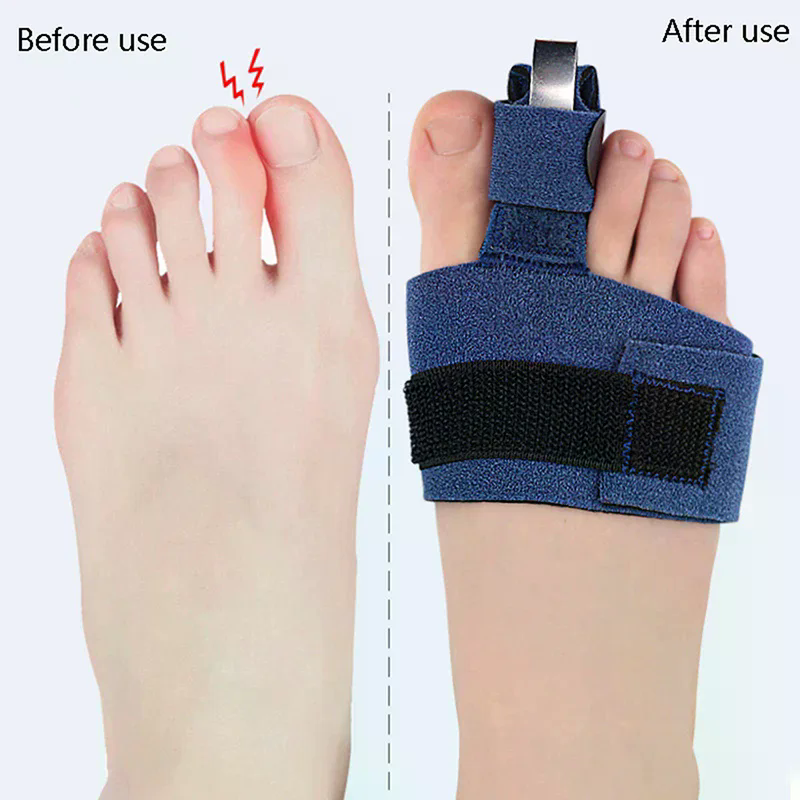 1Pcs Toe Corrector Toe Fractur - مراجعة Ankle Brace Sock وسعره